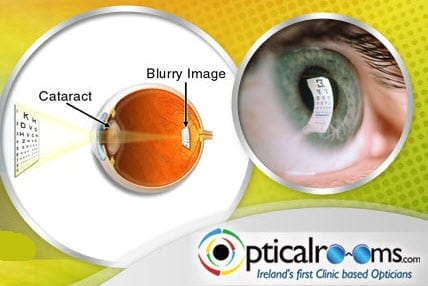 Cataracts