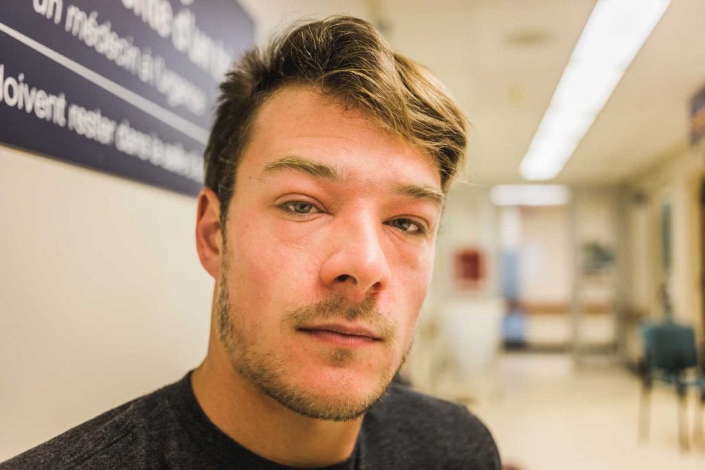 Allergies That Affect The Eyes