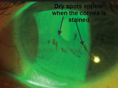 Dry spots on the cornea