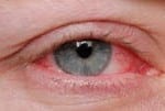 Eye allergy