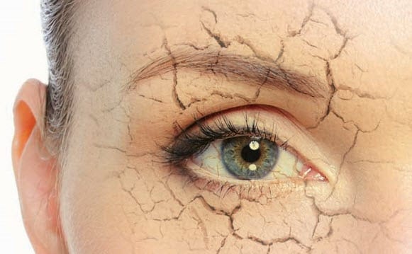 Dry_eyes