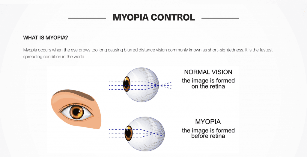 Myopia Control