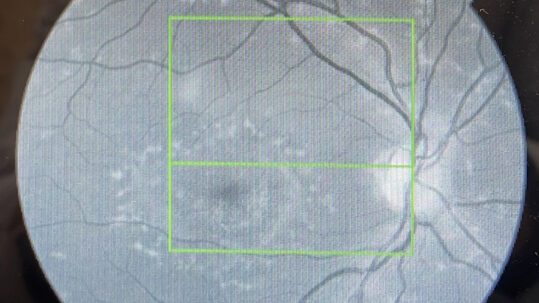 Red Free Retinal Drusen Image