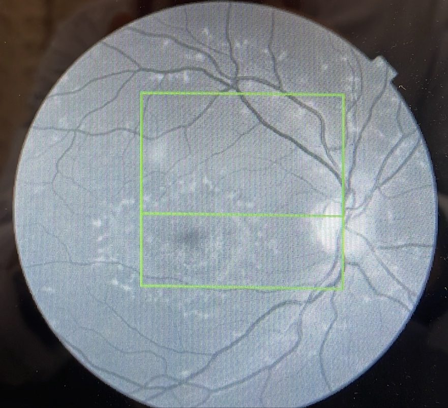 Red Free Retinal Drusen Image